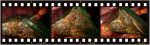 film_strip_augmented_liver